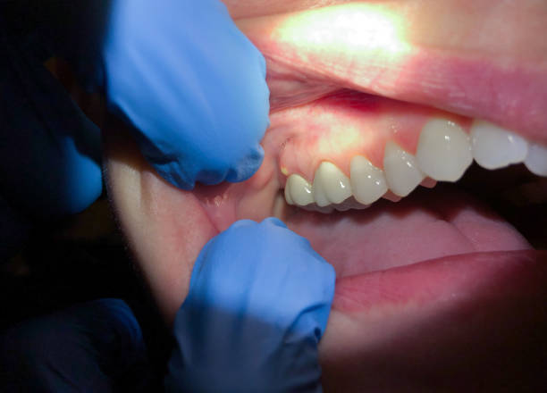 Best Broken or Chipped Tooth Repair in Upper Brookville, NY